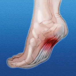 Plantar Fasciitis